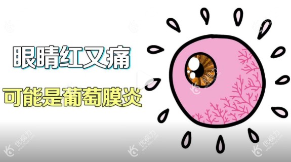 葡萄膜炎如何确诊