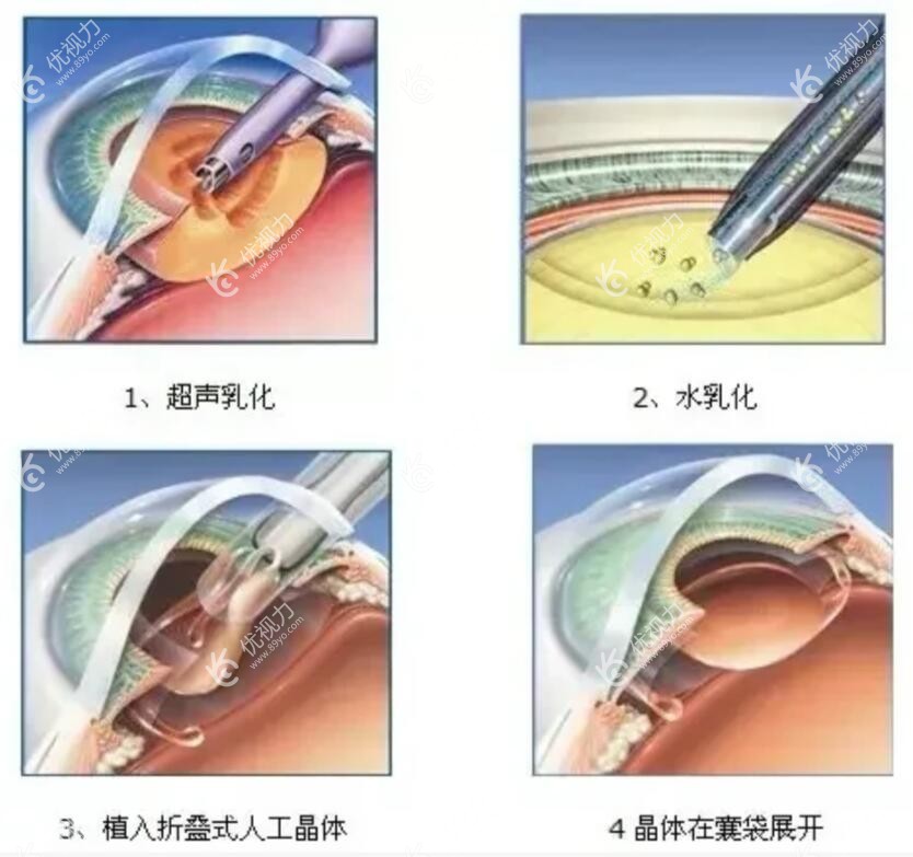 白内障晶体植入手术的原理