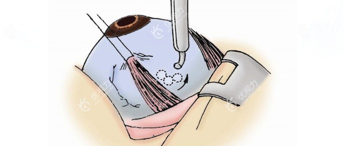 后巩膜固定术怎么做用把眼球取出来吗？