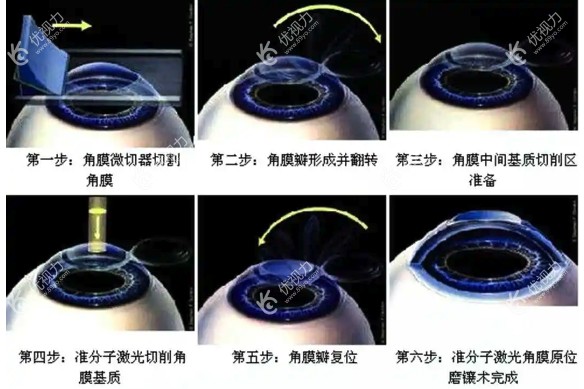 蔡司全飞秒手术优点