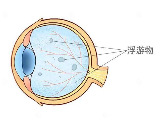 玻璃体混浊不治会加重吗m.89yo.com