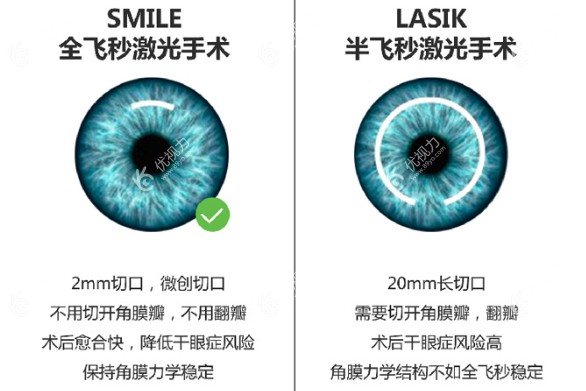 成人近视眼矫正手术如何做呢