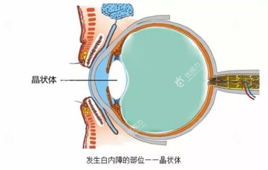先天性白内障的症状