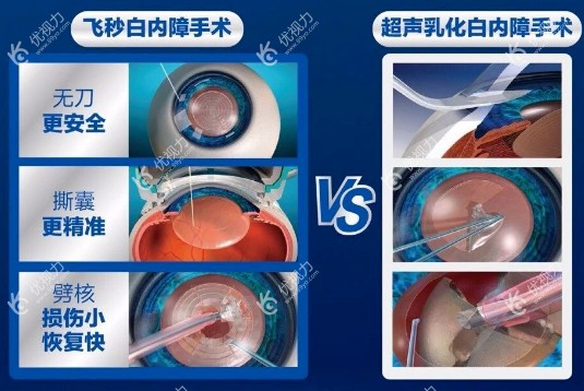 白内障做激光手术m.89yo.com