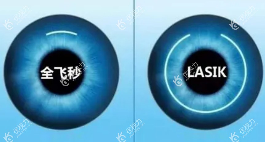 全飞秒手术