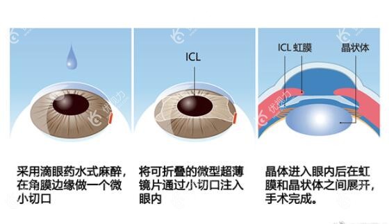 燕振国做晶体植入近视手术好价格不贵