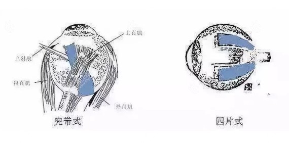 12岁600度可以做后巩膜加固手术吗