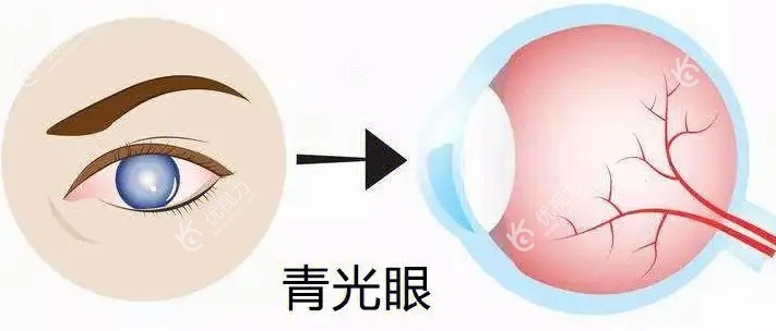 青光眼症状和表现有哪些89yo&.com