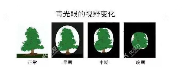 一张图测试自己是否有青光眼