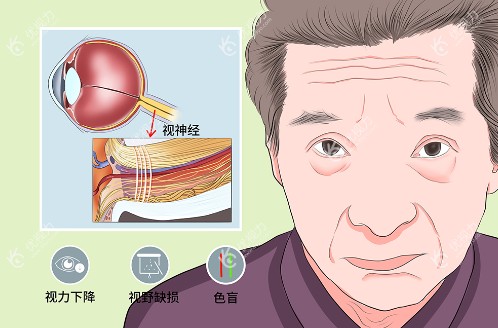 视神经萎缩