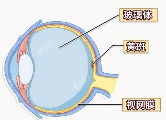 后视网膜脱离导致黄斑裂孔怎么治疗