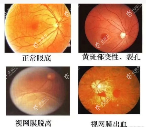 后视网膜脱离导致黄斑裂孔可以手术吗www.89yo.com
