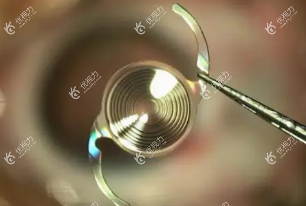 眼力健zxr00人工晶体缺点参考