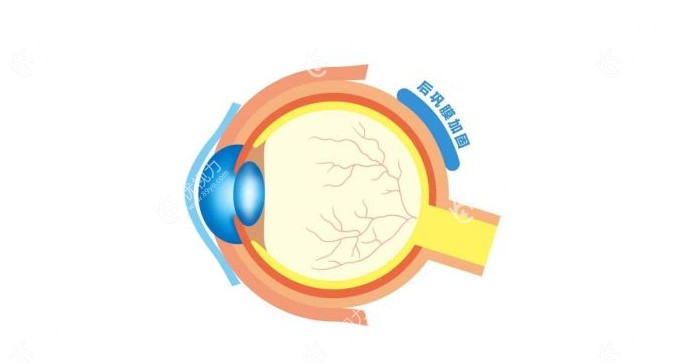 后巩膜加固术（优视力眼科网）