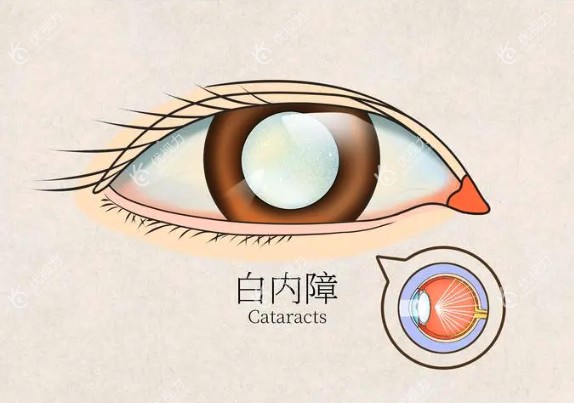 白内障晶体植入后视力模糊怎么办有补救的办法吗