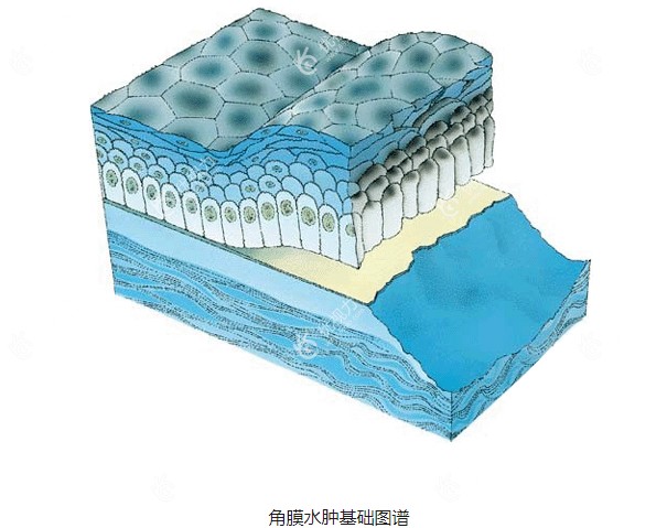 眼角膜水肿的诱因