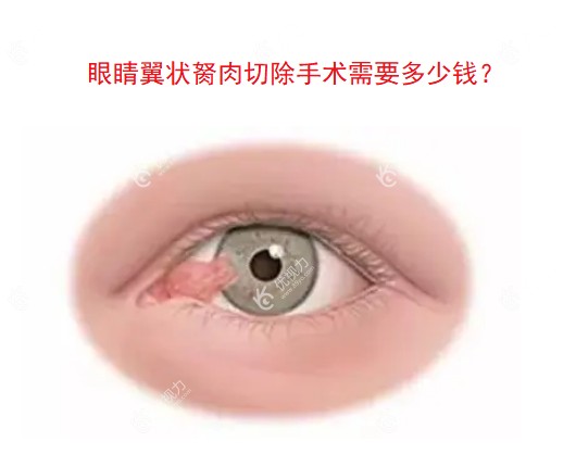 眼睛翼状胬肉切除手术需要多少钱