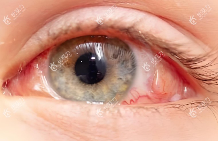 视网膜脱落后眼睛会变成怎样?视力下降视野受限,还会造成心理压力与社会功能受损
