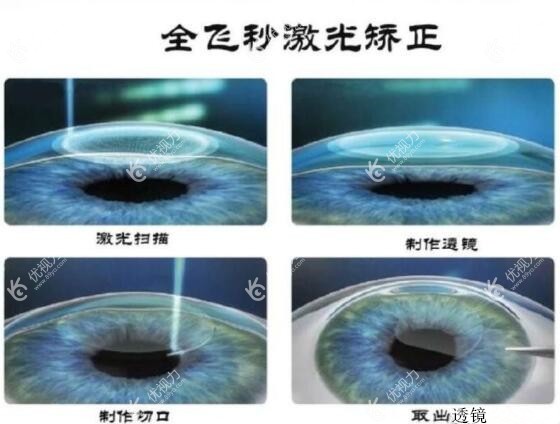北京爱尔英智眼科做全飞秒激光近视手术价格