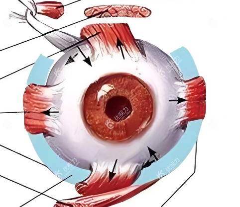 后巩膜加固术后视力能提高多少?可控制近视增长,达到术前配镜水平