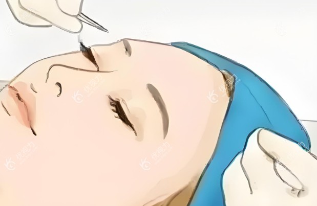 眼睛手术