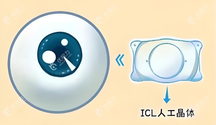 潍坊明润眼科ICL晶体近视手术好