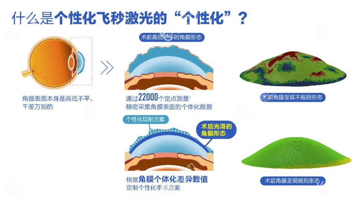 激光近视眼手术