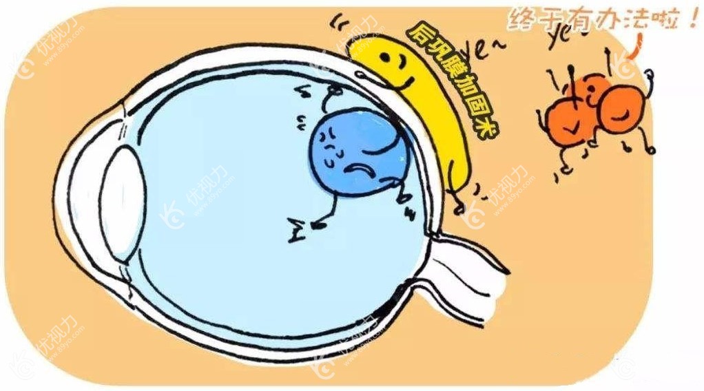 后巩膜加固术